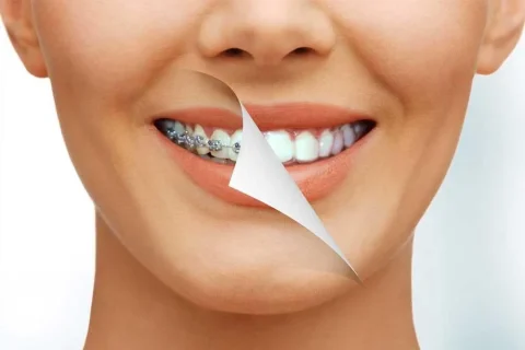 ابتسامة هوليوود