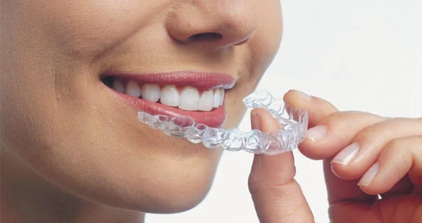 Clear aligners in Kuwait and case suitability assessment