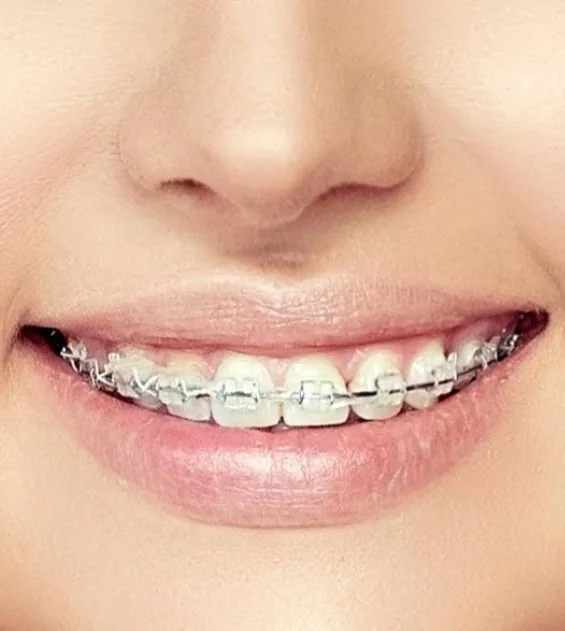 Comparison between metal braces and clear aligners in Kuwait