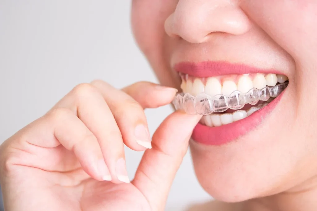 Clear Aligners in Kuwait