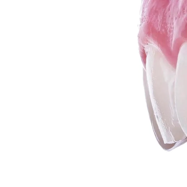 Clear Aligners at Lotus Clinic Kuwait
